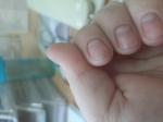 Черные полоски на ногте в виде заноз фото 1