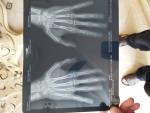Открыты ли зоны роста по рентген снимкам кистей рук фото 5