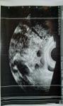 Увеличен правый яичник (фото УЗИ) фото 1