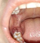 Эпулис(?) у ребенка над растущим зубом или гнойное воспаление? фото 1