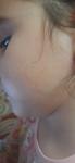 Высыпания на щеках у ребёнка 7 лет фото 3