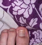 Трескается кожа около ногтя большого пальца руки фото 1