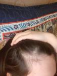 Линия роста волос или аллопеция фото 3