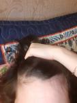 Линия роста волос или аллопеция фото 1