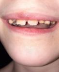 Скол постоянного зуба у ребенка фото 1