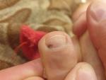 Пятно на ногте пальца ноги фото 1