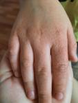 Сыпь на кистях рук у ребенка фото 1