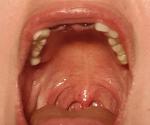 Красные пятна на нёбе, гортани после удаления зубов и имплантации фото 5