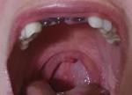 Красные пятна на нёбе, гортани после удаления зубов и имплантации фото 2