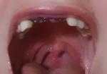 Красные пятна на нёбе, гортани после удаления зубов и имплантации фото 1