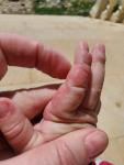 Чем лечить палец и возможная причина? фото 5