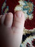 Вертикальные полосы на ногтях ноги фото 1