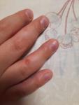 Аллергия или грибок на руках и ногтях у ребенка 4 лет фото 2