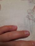 Аллергия или грибок на руках и ногтях у ребенка 4 лет фото 1