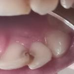 Кариес на зубе фото 2