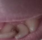 Кариес на зубе фото 1