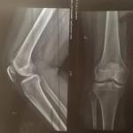 Рентген коленного сустава у девушки фото 1