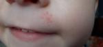 Сыпь на лице ребёнка и гнойник в носу фото 2