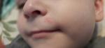 Сыпь на лице ребёнка и гнойник в носу фото 1