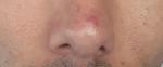 Красная пятно на носу 4-5 месяцев не проходит фото 1