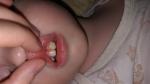 После лечения пульпита зуб пожелтел фото 1