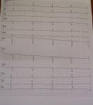 Расшифровка кардиограммы и диагнозов фото 1