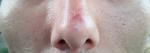 Красная пятно на носу 4-5 месяцев не проходит фото 2