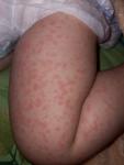Токсико-аллергичечкий дерматит фото 2