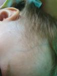 Пятна светло-желтые на голове шее и висках ребёнок 3 года фото 3