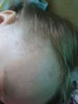 Пятна светло-желтые на голове шее и висках ребёнок 3 года фото 2