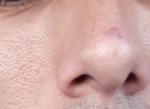 Красная пятно на носу 4-5 месяцев не проходит фото 3