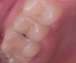 Чернота в зубе фото 1