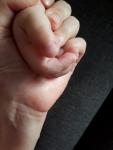 Высыпания на пальцах рук ребенка фото 2