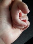 Высыпания на пальцах рук ребенка фото 3