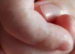 Высыпания на пальцах рук ребенка фото 1