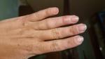 Отек пальца после пореза и ношения лангета фото 1