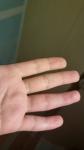 Отек пальца после пореза и ношения лангета фото 2