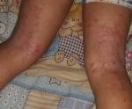 Аллергия с красными пятнами и кровью фото 1
