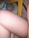 Сыпь у маленького ребёнка фото 2