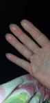Пузырьки на пальцах рук фото 3