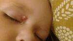 Большое уплотнение над глазом и бровью у ребенка фото 2