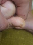 Беспокоит коричневое пятно на ноге на 2-пальце фото 1