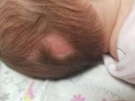 Помогите разобраться, что за лысое пятно на голове у новорожденного фото 1