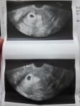 Беременность и синехея фото 2