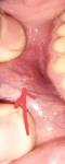 Вздутие на внутренней части губы фото 2