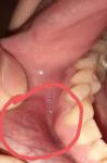 Вздутие на внутренней части губы фото 1