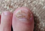 Грибок ногтя или следствие травмы фото 1