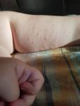 Сыпь на руках и ногах ребенка без зуда фото 1