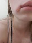 Болячки возле губ фото 1