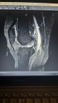 Лфк при частичном разрыве пкс коленного сустава и медиального мениска фото 2